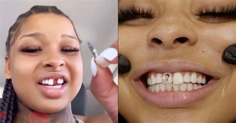 chrisean teeth|Chrisean Rock Shares New Video Of Her Smile After